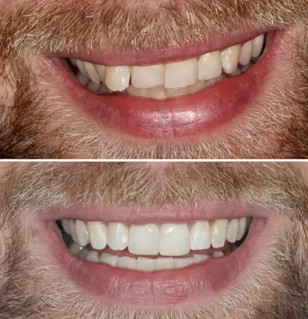 Invisalign-before-and-after-5-600x622
