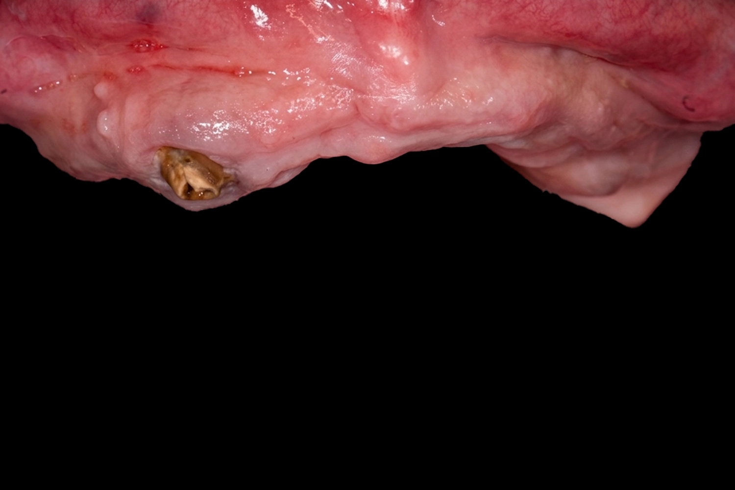 Înainte de tratamentul cu implant dentar