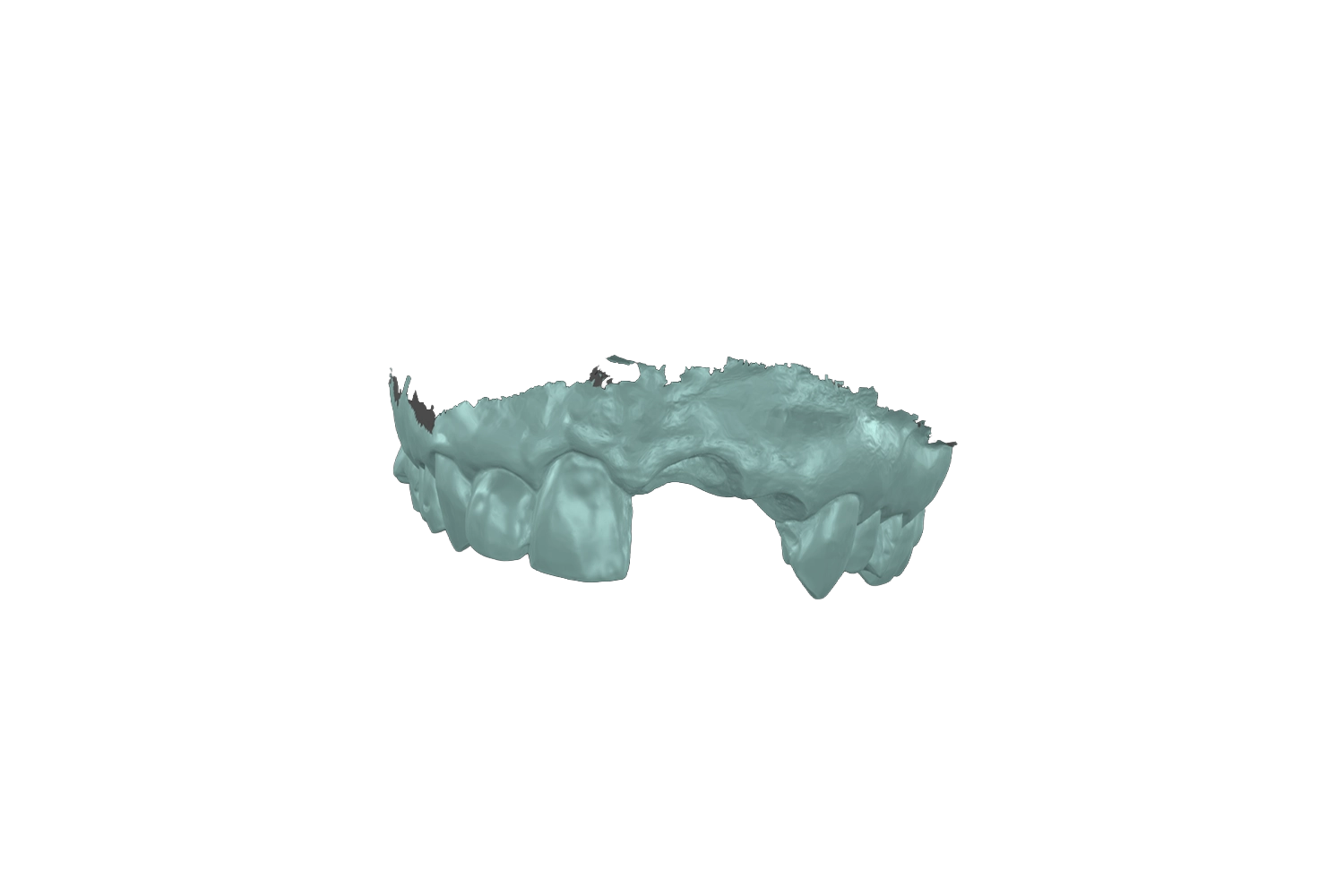 Scanare digitală 3D completă utilizată pentru planificarea implantului